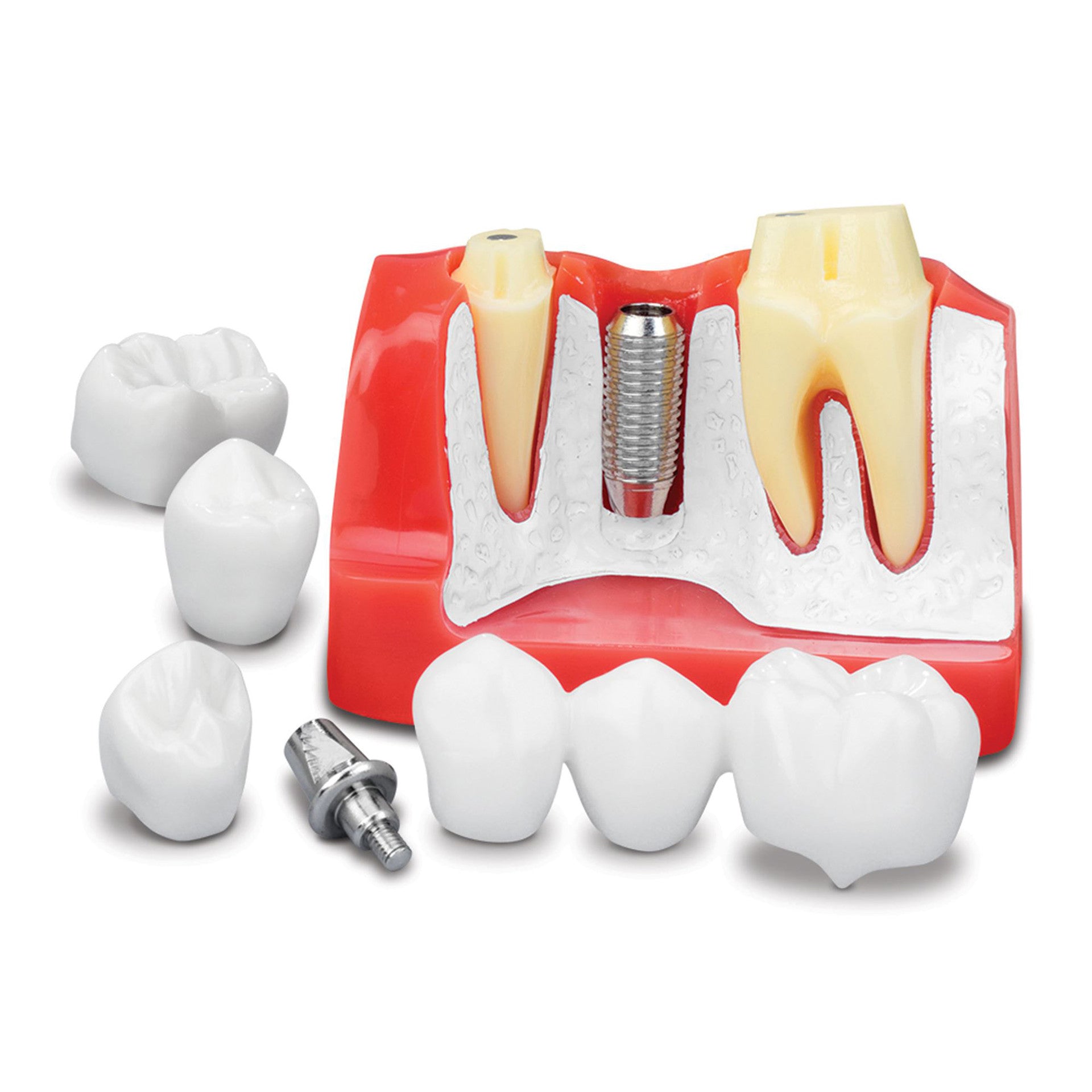 Practicon 7135611 Dental Implant Analysis Model To Explain Treatment Options