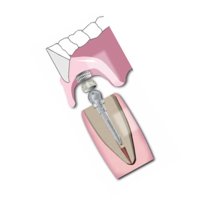 Essential Dental Systems 290-01 Flexi-Overdenture Capsules 6 Per Vial