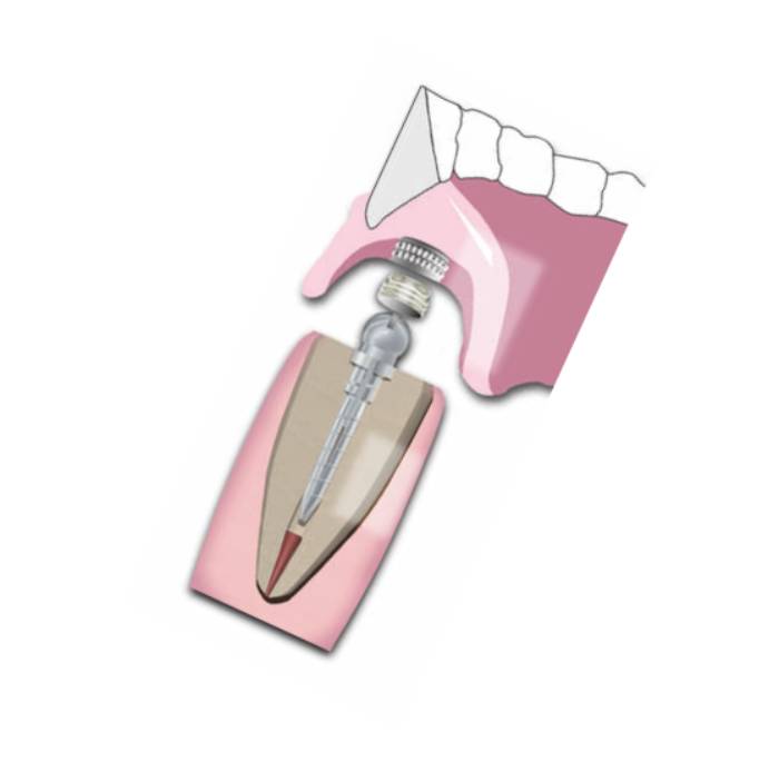 Essential Dental Systems 290-01 Flexi-Overdenture Capsules 6 Per Vial