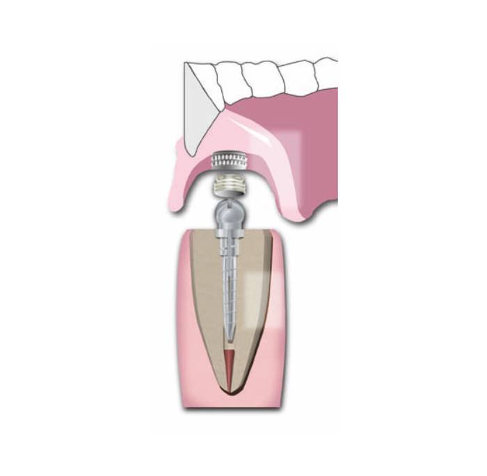 Essential Dental Systems 290-01 Flexi-Overdenture Capsules 6 Per Vial